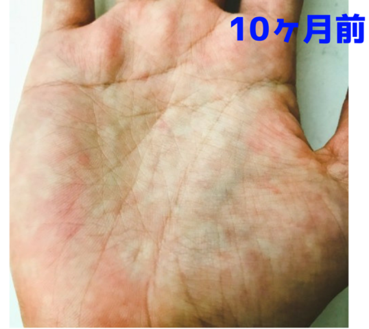 手相　変化　期間　周期　左手　写真　運命　10ヶ月前の手のひら　青い文字　少し赤い斑点